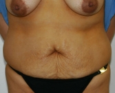 Feel Beautiful - Tummy Tuck Case 29 - Before Photo